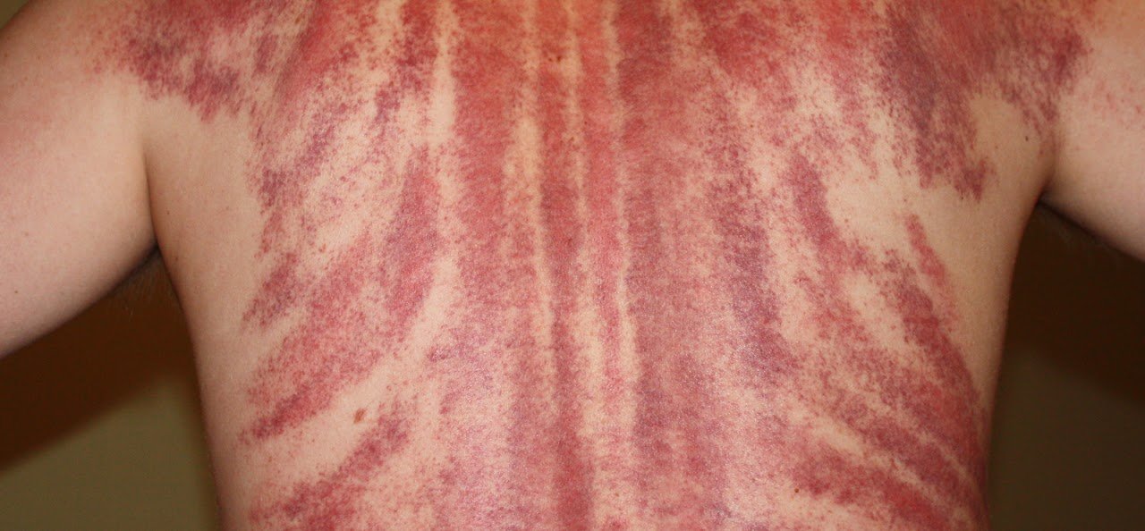 gua sha 刮痧 gua sha 刮痧